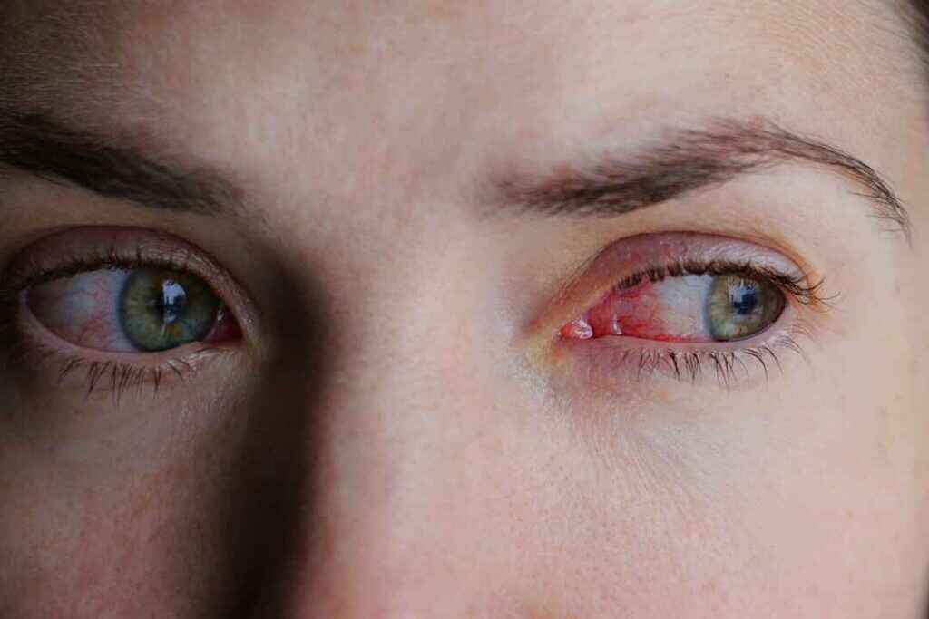 Using EMDR in RECOvery