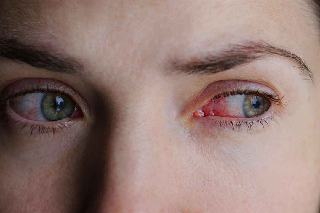 Using EMDR in RECOvery
