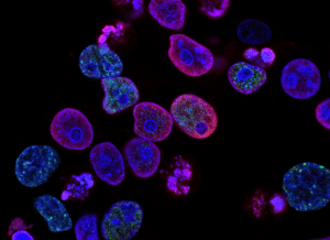 Inflammatory Biomarker Investigation